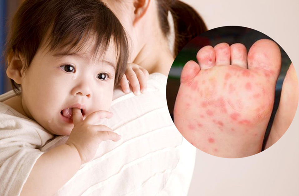 Bệnh tay chân miệng là bệnh khá nguy hiểm ở trẻ.