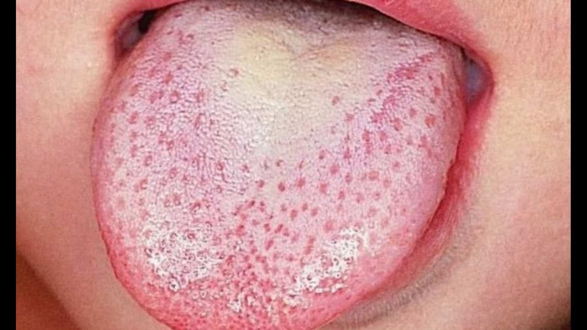 Hình ảnh lưỡi bé bị tưa lưỡi