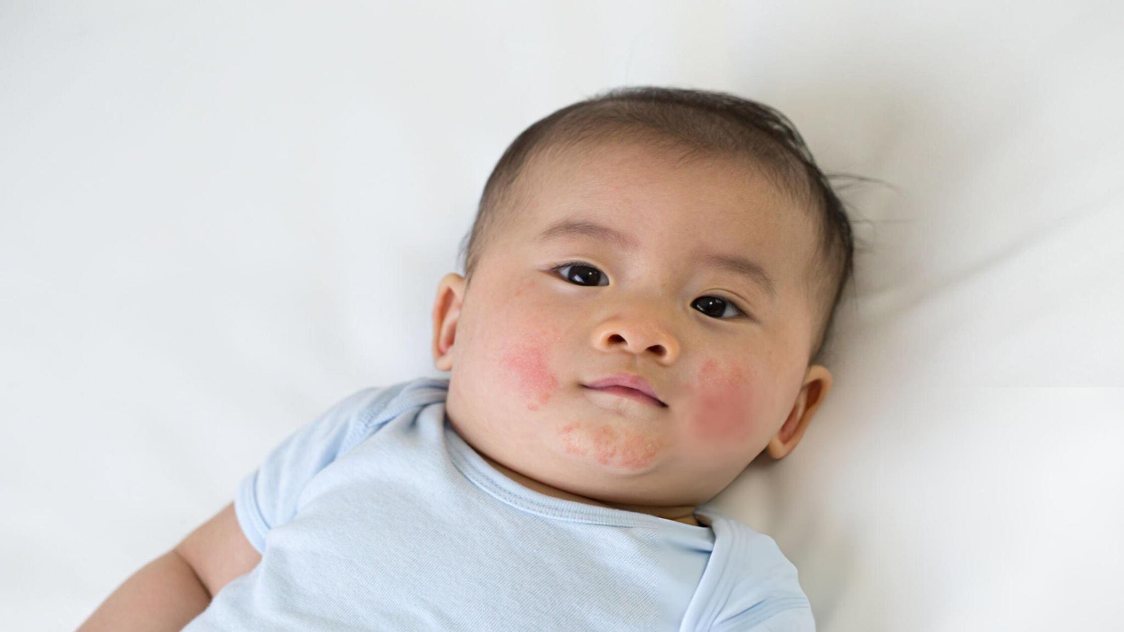 Cách trị rôm sảy cho trẻ sơ sinh vào mùa hè nóng bức an toàn