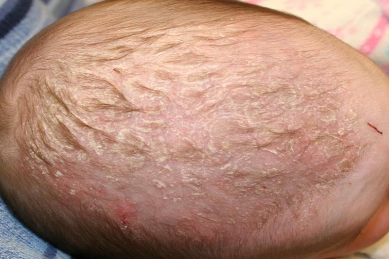 Cách loại bỏ cứt trâu viêm da tiết bã trên đầu trẻ sơ sinh an toàn
