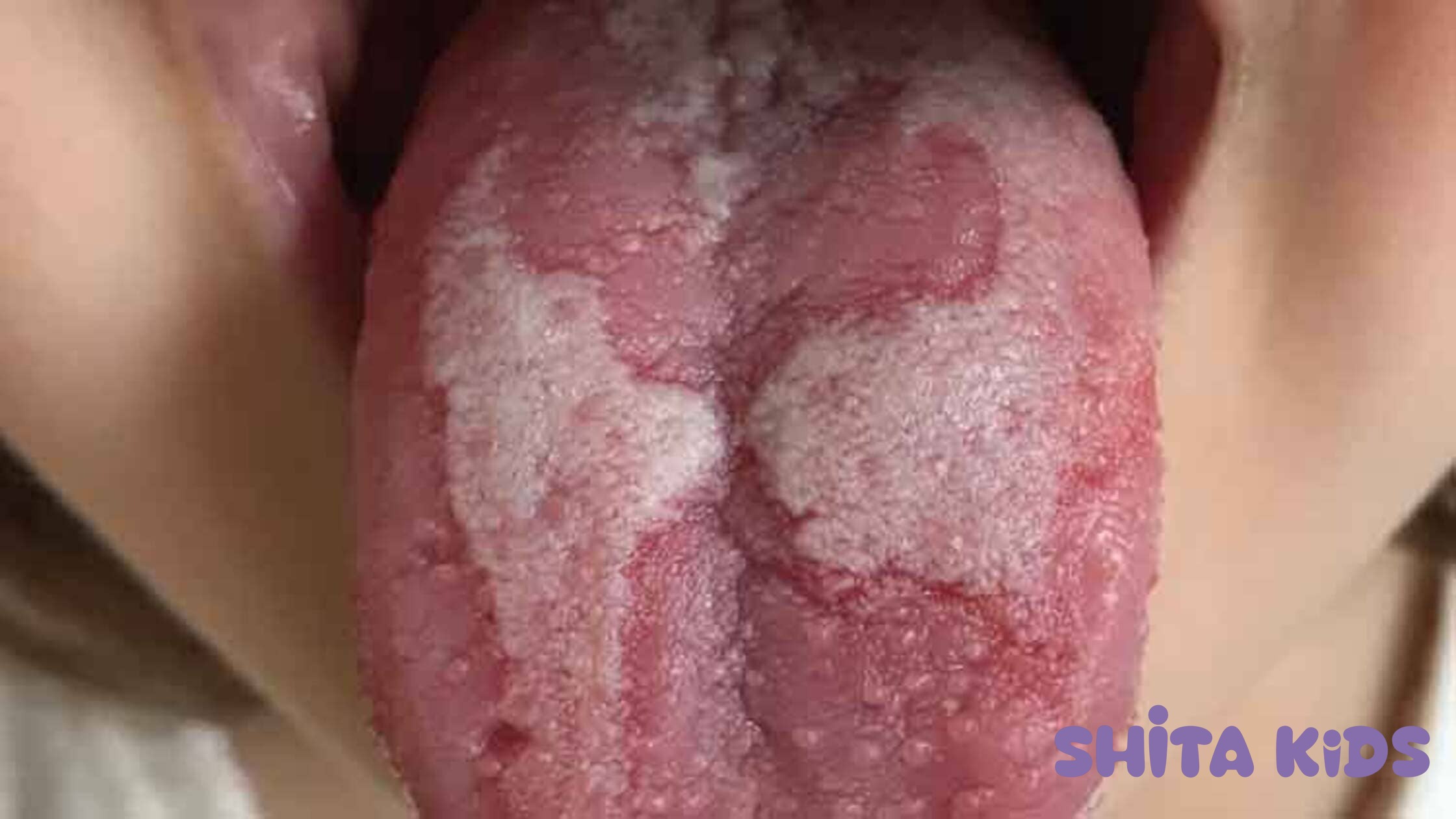 Viêm lưỡi bản đồ là tình trạng lành tính do mất gai lưỡi chứ không phải nấm mốc nguy hiểm.