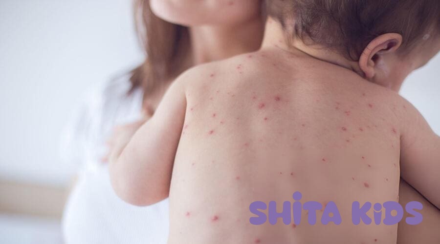 dấu hiệu da bé bị trầy xước hoặc mưng mủ tuyệt đối không nên tắm nước lá
