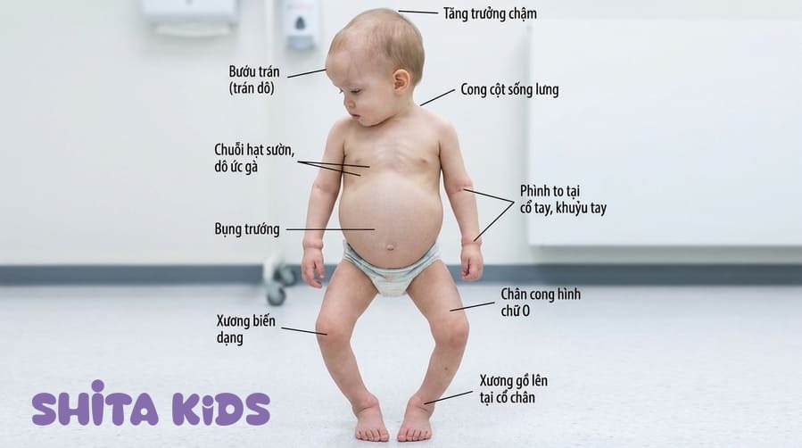 Thóp đầu bé rộng và chậm đóng hơn mốc bình thường — dấu hiệu bé còi xương sơ sinh.