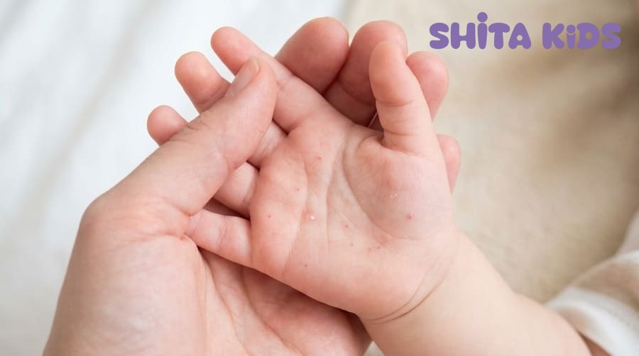 Nốt phỏng tay chân miệng trên lòng bàn tay bé nhỏ